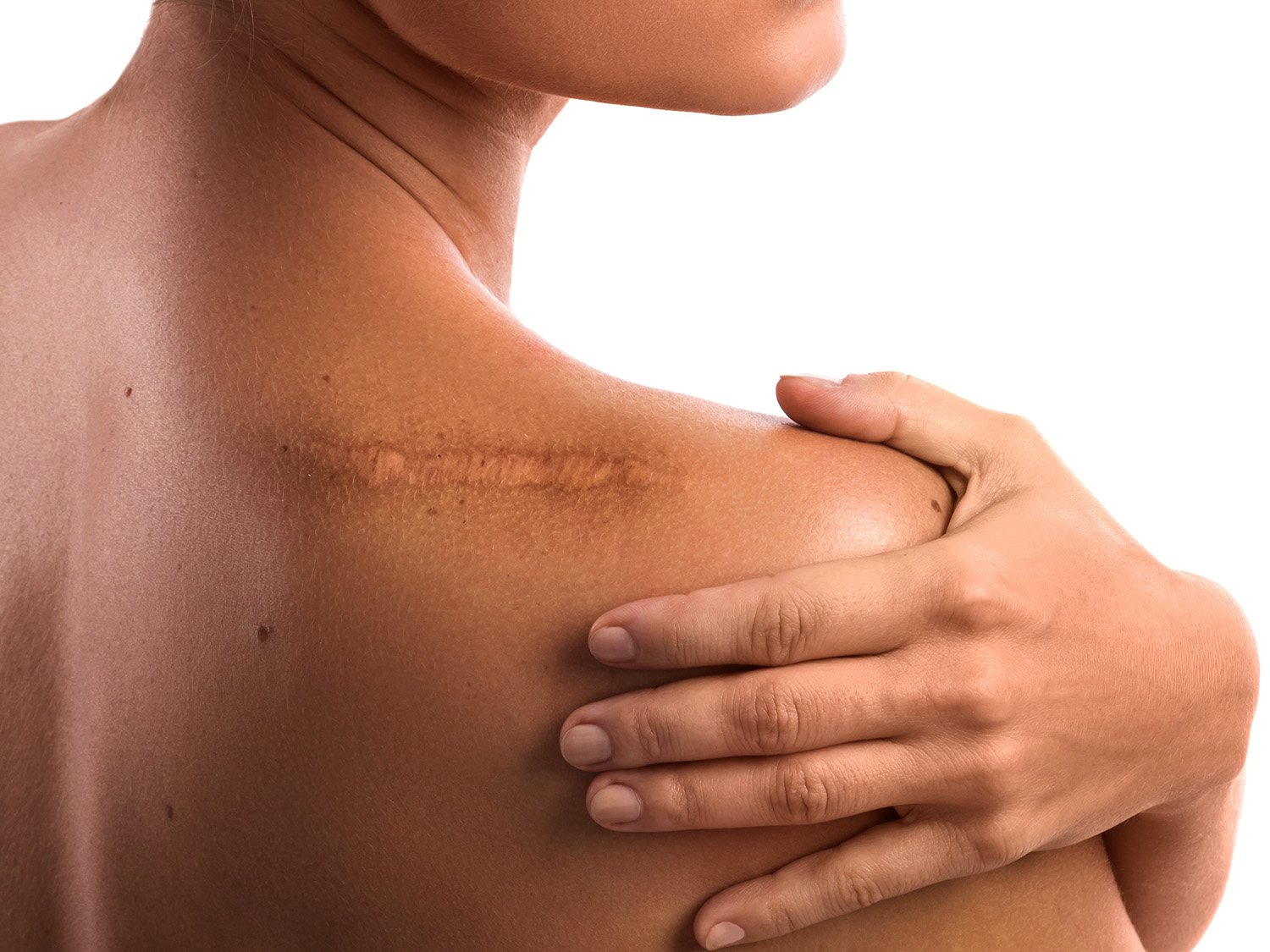 Natural Remedies for Scars After Surgery - Mend Well Blog